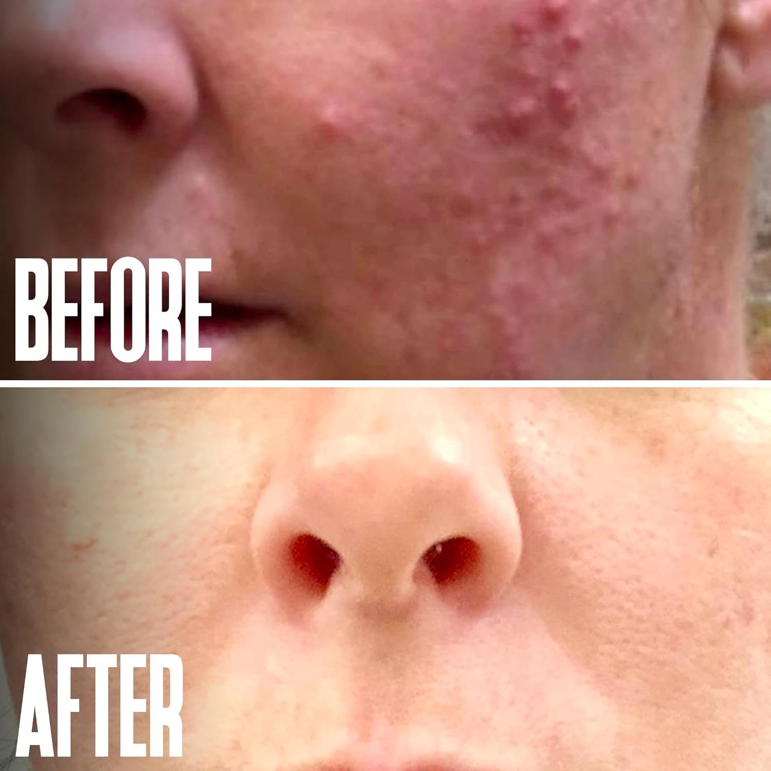 Glycolic Acid Peel 40% Professional Chemical Peel for Acne Scars, Collagen Boost- Alpha Hydroxy Acid