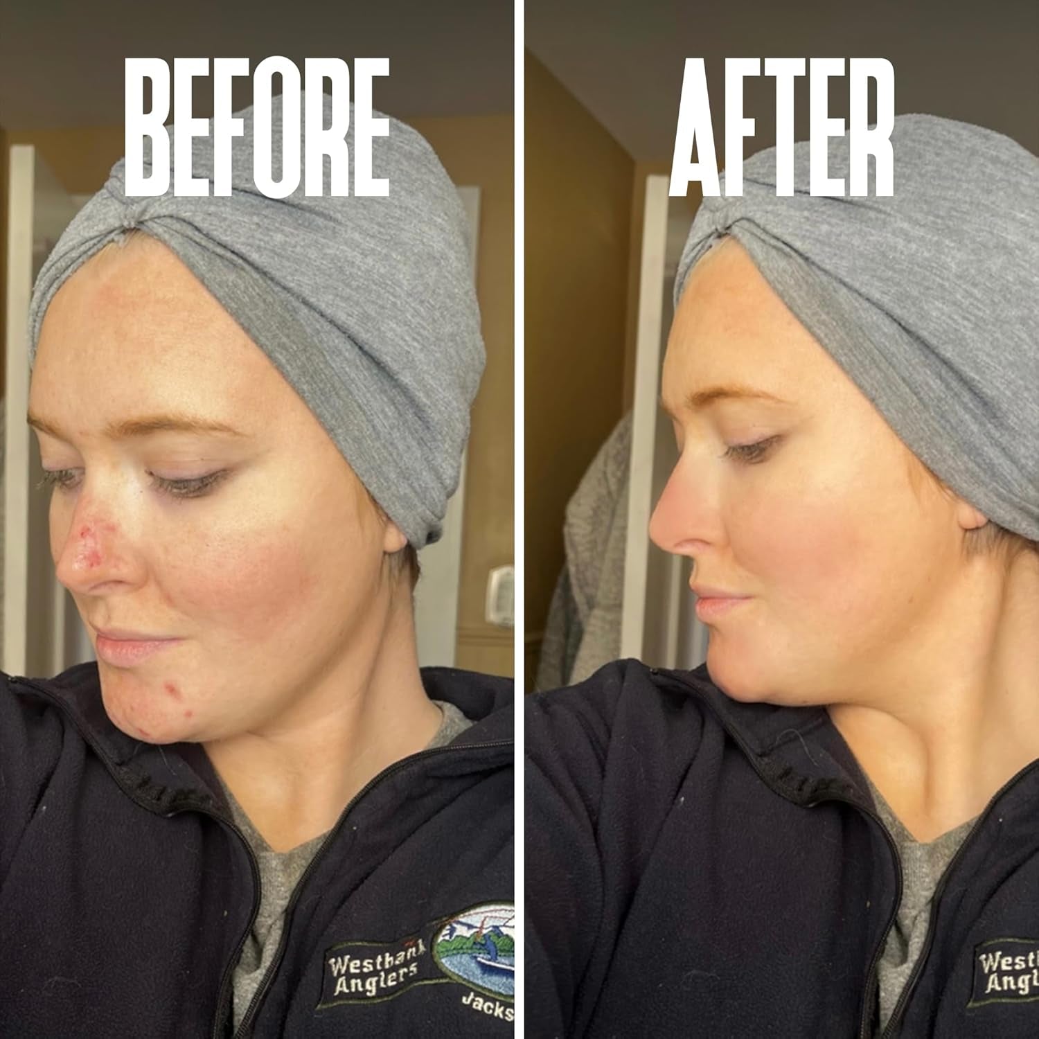 Glycolic Acid Peel 40% Professional Chemical Peel for Acne Scars, Collagen Boost- Alpha Hydroxy Acid